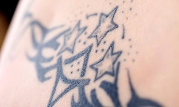 $21 for $100 Worth of Tattoo Removal Services at Eraser Clinic Laser Tattoo Removal