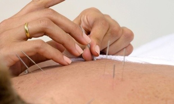 $20 for $40 Worth of Acupuncture at Dowling Community Acupuncture