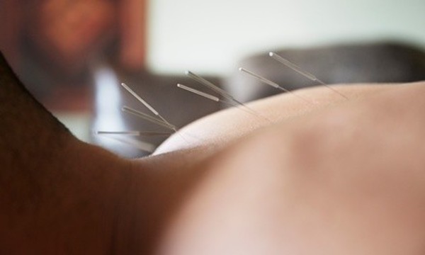 Initial Consultation with One Acupuncture Treatment at Chinese Acupuncture and Herb Center