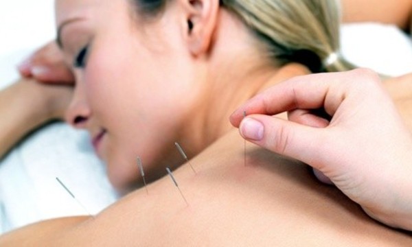 One or Three Acupuncture Packages at Bethesda Chiropractic & Acupuncture Clinic (Up to 79% Off)