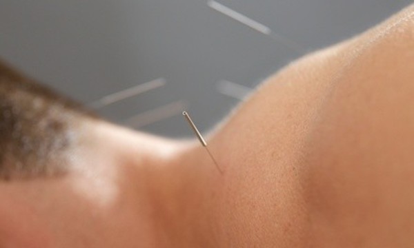 One or Three 60-Minute Acupuncture Sessions at The Gathering Point Community Acupuncture (Up to 55% Off)