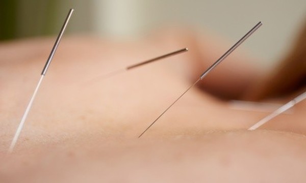 One, Three, or Five Acupuncture or Cupping Sessions at Mafa Holistic (Up to 53% Off)