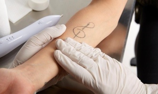 Tattoo Removal Session for Small, Medium, or Large Area at Miraculous Creations (Up to 42% Off) 