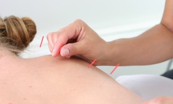 $52 for a Comprehensive Exam & Two Acupuncture Sessions ($215 Value) 