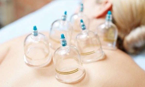 One or Two Cupping Sessions at AB Acupuncture (Up to 56% Off)