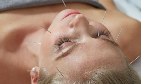 One or Two Acupuncture Treatments & Consultation at CA Clinic Acupuncture & Chiropractic Wellness (Up to 75% Off)