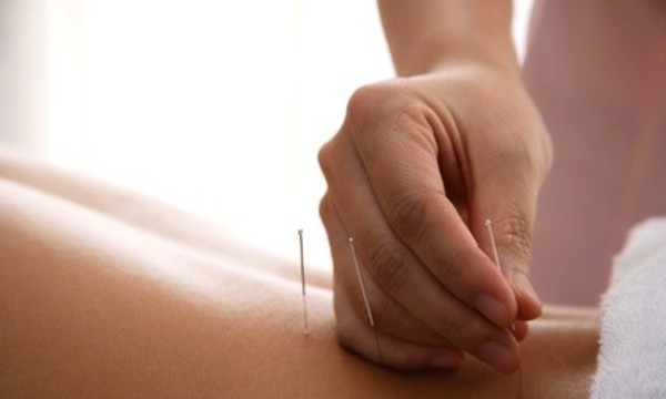 One or Three 45-Minute Acupuncture Sessions at Wolke Chiropractic & Rehabilitation (Up to 92% Off)