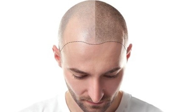 Scalp Micropigmentation and Initial Consultation for Small, Medium, or Large Areas at Scalp Ink (Up to 98% Off)