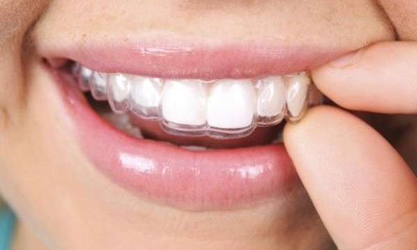 One Invisalign or My Smile Imagined Package at Whitten Dentistry (Up to 97% Off)