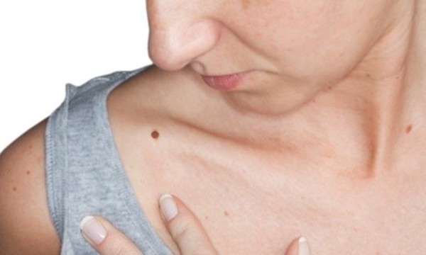 Removal of 1, 3, 6, or 15 Skin Tags or Brown Spots or 2 Moles at Just For You Salon & Spa (Up to 76% Off)