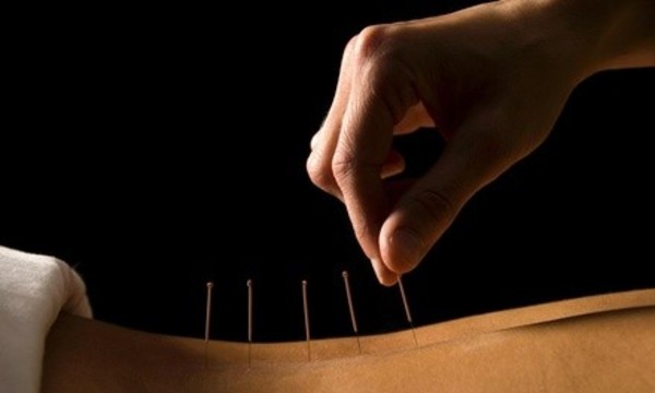 An Acupuncture Treatment at Matawan Wellness Center (51% Off)