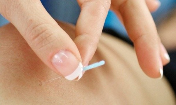 One or Three Acupuncture Sessions at Taichi Acupuncture (Up to 54% Off)