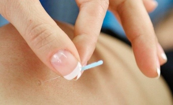 Initial Appointment and One or Two Acupuncture Treatments at Baltimore Acupuncture Center (Up to 75% Off)
