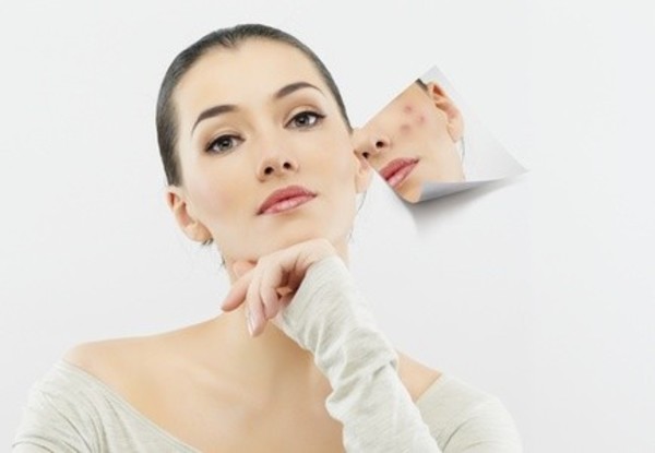  Ematrix Acne Scar Reduction at Body and Soul Medical and Holistic Spa (Up to 46% Off). Two Options Available. 