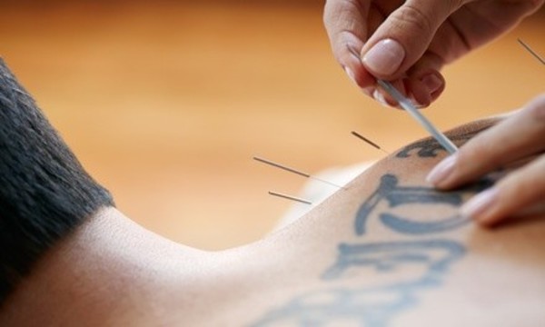 One or Three 30-Minute Acupuncture Sessions at Midwest Center for Health & Wellness, Inc. (Up to 76% Off)