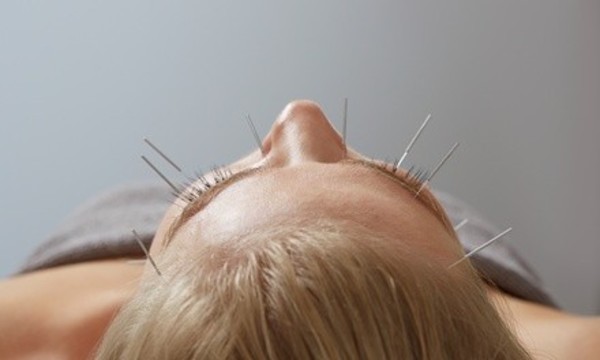 One, Three, or Five Acupuncture Treatments at Samra Acupuncture Clinic (Up to 72% Off)