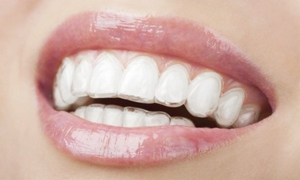 $49 for $1,000 Towards Full Invisalign Treatment or Traditional Braces at Bubon Orthodontics