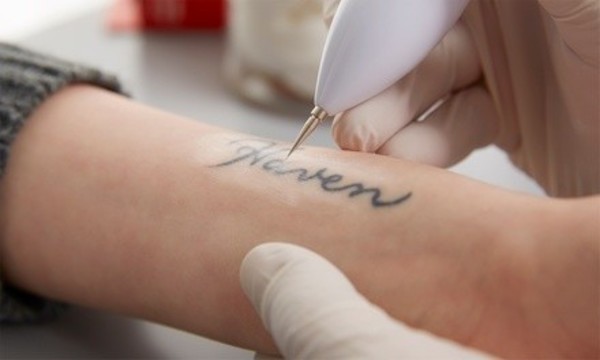Three Tattoo Removal Treatments on a Small or Medium Area at Legacy MD (Up to 51% Off)