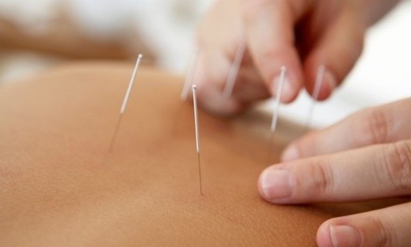 Initial Consultation and Dry Needling Session at Elite Chiropractic (Up to 80% Off). Two Options Available.