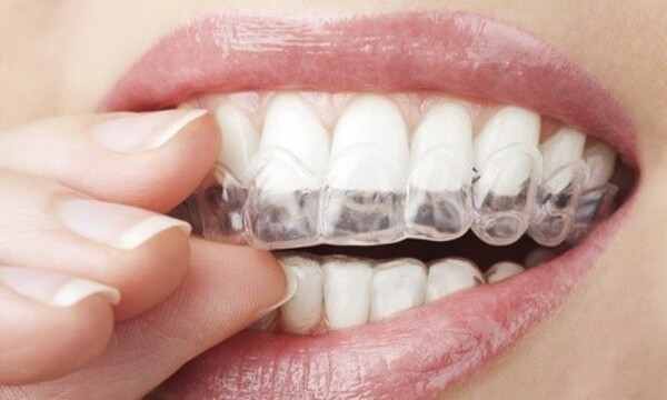 $28 for Aligner Consultation and $500 Value Towards Service at BeFree Wellness ($94 Value)