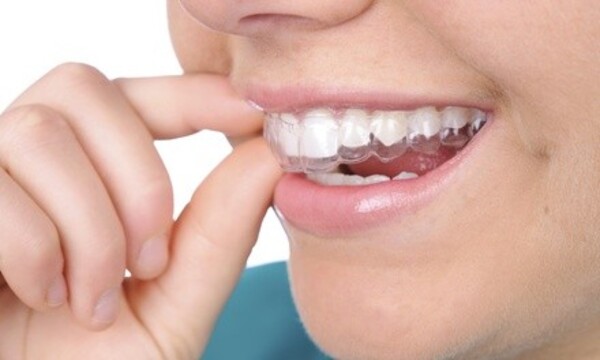 $30 for $1,500 Worth of Invisalign at Regal Dentistry