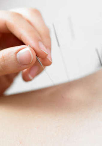 One 30-Minute Acne Regular Facial or Acne Back Facial at Avaaesthetics (Up to 61% Off)