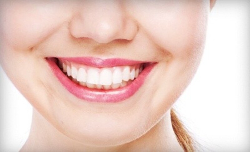 One Porcelain or Composite Veneer with Cleaning, Exam, and X-rays at Avenue Dental (Up to 53% Off)