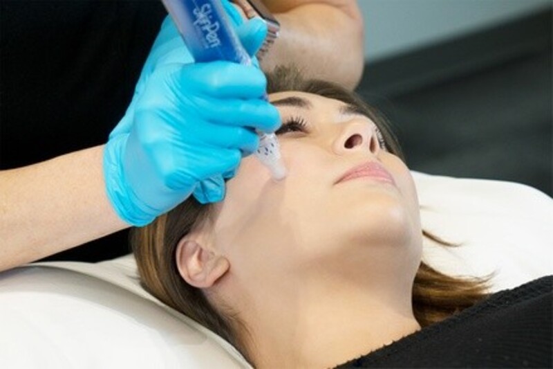 One or Two Professional Microneedling Sessions at Body By Design Charleston (Up to 49% Off)