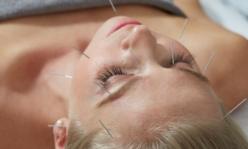 One or Two Acupuncture Treatments & Consultation at CA Clinic Acupuncture & Chiropractic Wellness (Up to 80% Off)