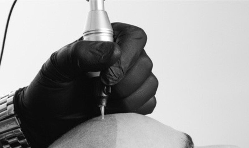 $3,300 for $5,500 Worth of Scalp Micropigmentation at Scalp Aesthetics