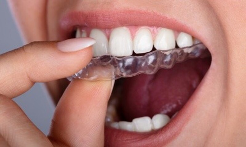 $2,399 for Clean Aligners with Consultations, X-Rays, and Retainers at Edward Shluper DDS ($5,500 Value)
