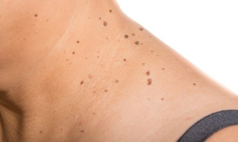 Treatment of Three Skin Anomalies or Neck or Underarm Skin Tags with Skin Classic at A Beautiful Face & Skin Care