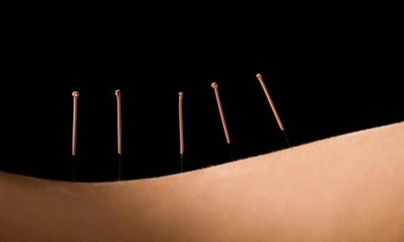 Up to 66% Off Acupuncture  at Wise Wellness