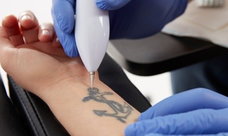 One, Three, or Six Laser Tattoo-Removal Sessions at Wise Choice Tattoo Removal (Up to 76% Off)