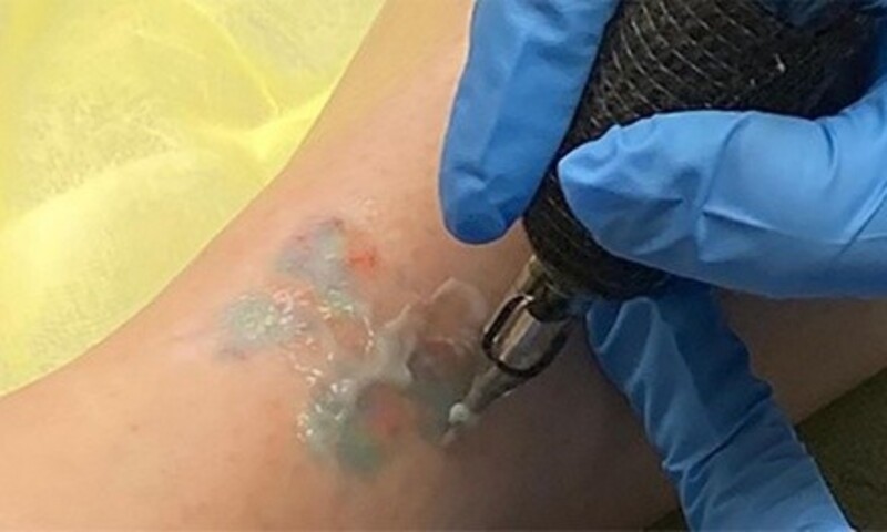 Non-Laser Tattoo-Removal Session on an Area up to 4, 9, or 16 Square Inches at Scalp Ink (Up to 50% Off)