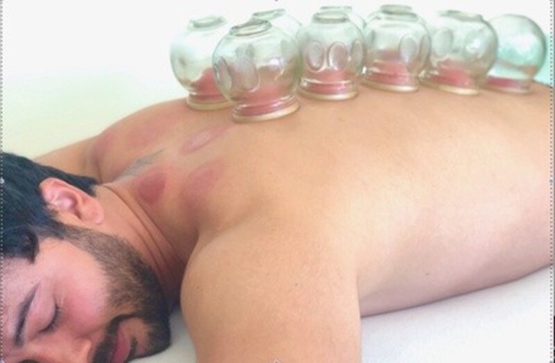 Up to 64% Off on Cupping at Acupuncture By The Sea, Melissa Kallsen, LAc