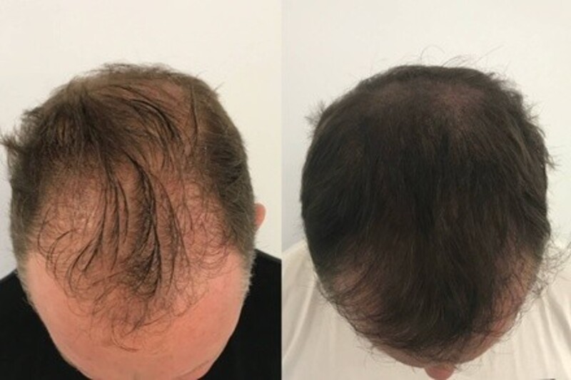 Up to 38% Off on Salon - Scalp Care at JaCaos