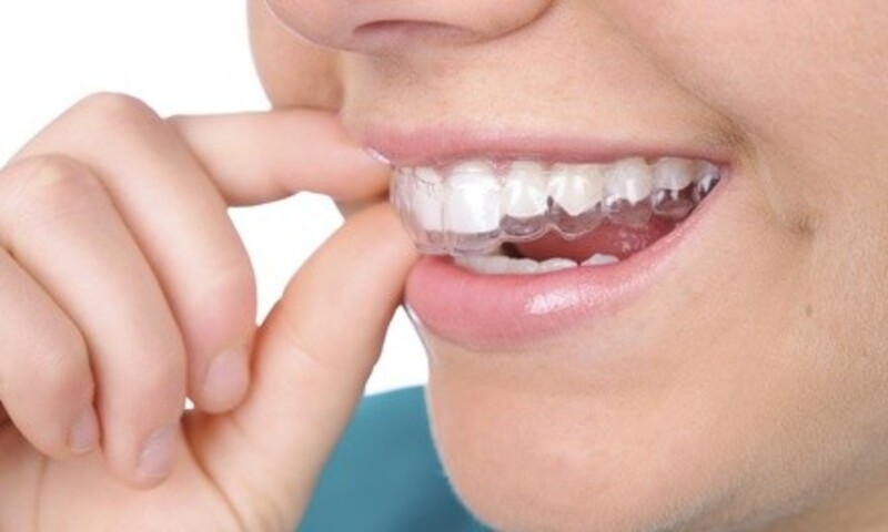 $25 for $2,000 Toward a Complete Invisalign or Braces Treatment at Crown Point Dental Care