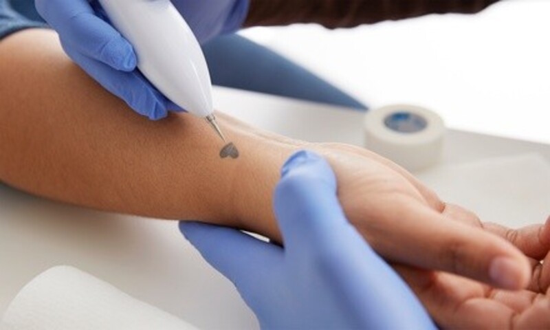 One or Two Tattoo-Removal Sessions at Nu You Wellness (Up to 75% Off)