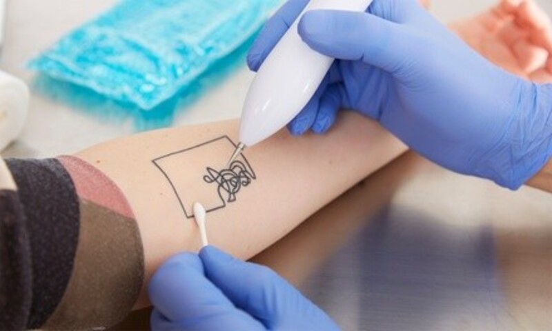 Three Laser Tattoo-Removal Sessions at Salon and Day Spa (Up to 58% Off). Three Options Available.