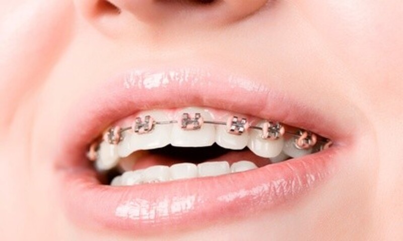 $55 for Consultation, X-Rays, Whitening, and $1,000 Value Towards Invisalign or Braces ($1,350 Value)