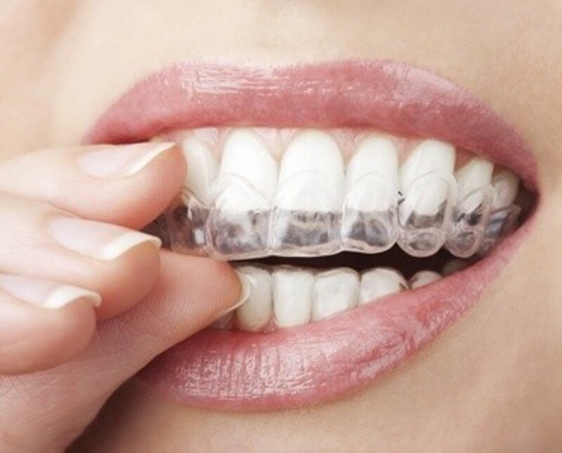 $39 for $1,000 Toward Full Invisalign Treatment at Orthodontic Specialists