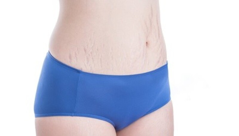 $150 for $300 Worth of ANY Salon Service or Combination of Services, including Stretch Mark Camouflage, Lipo Cavitation, Eye Lash Extentions or Skin Tightening Facials