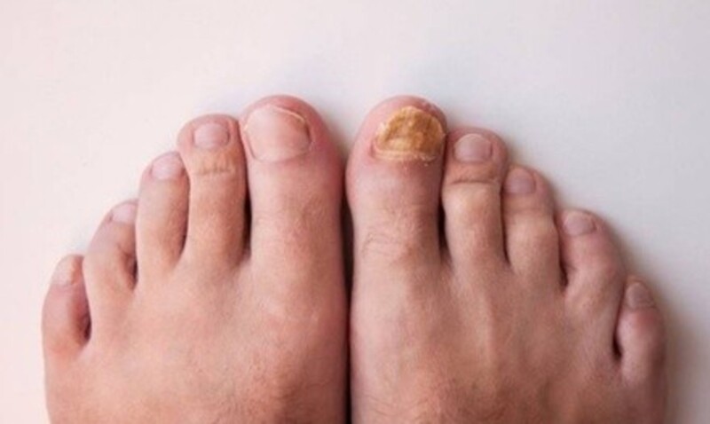 Toenail Fungus Treatment Initial Visit from Dr. Paul Brody (Up to 66% Off). Two Options Available.