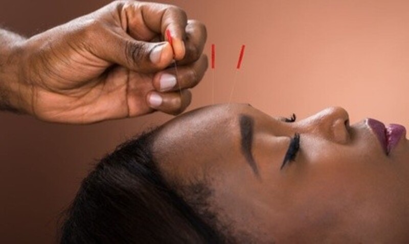 Up to 63% Off on Acupuncture Services at Dixon Chiropractic