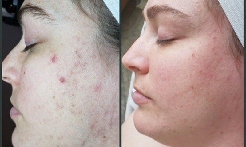 Up to 40% Off on Facial - Blemish Treatment at LACED ESTHETICS