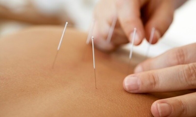 One or Three Acupuncture Sessions at McAndrew Chiropractic (Up to 42% Off)