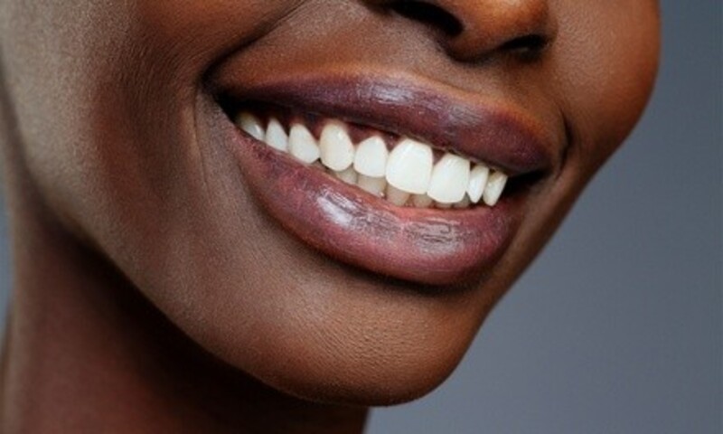 Package with Four, Six, Eight, or Ten Veneers at GF Dental (Up to 62% Off)