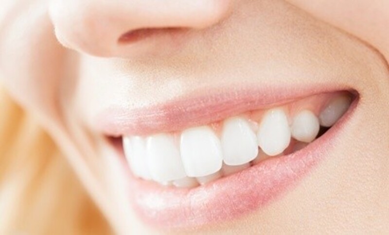 Up to 25% Off on Teeth Whitening at Whoa Teeth Whitening