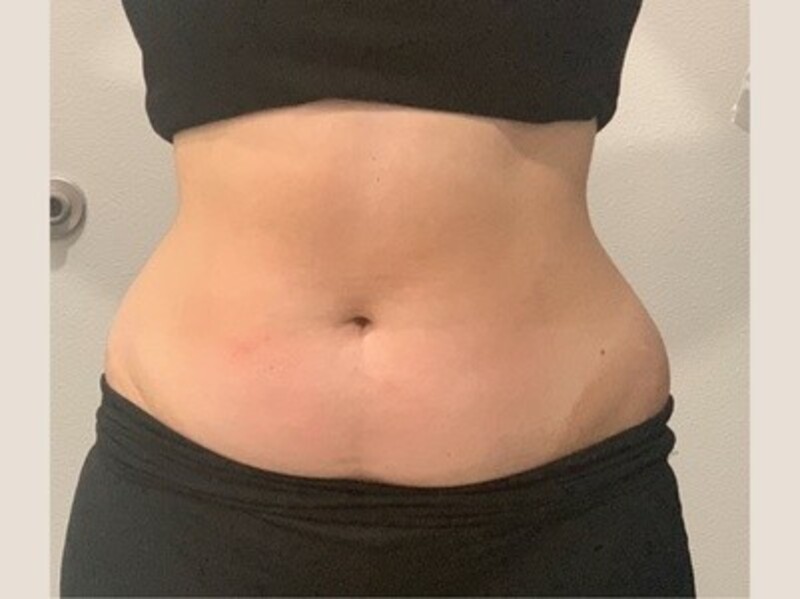 Up to 72% Off on Cavitation at Alchemy Skin